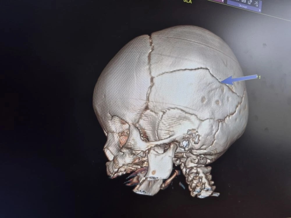 Малыша с переломом черепа после падения с кроватки санавиацией доставили из Балакова в Саратов Малыша с переломом черепа после падения с кроватки санавиацией доставили из Балакова в Саратов